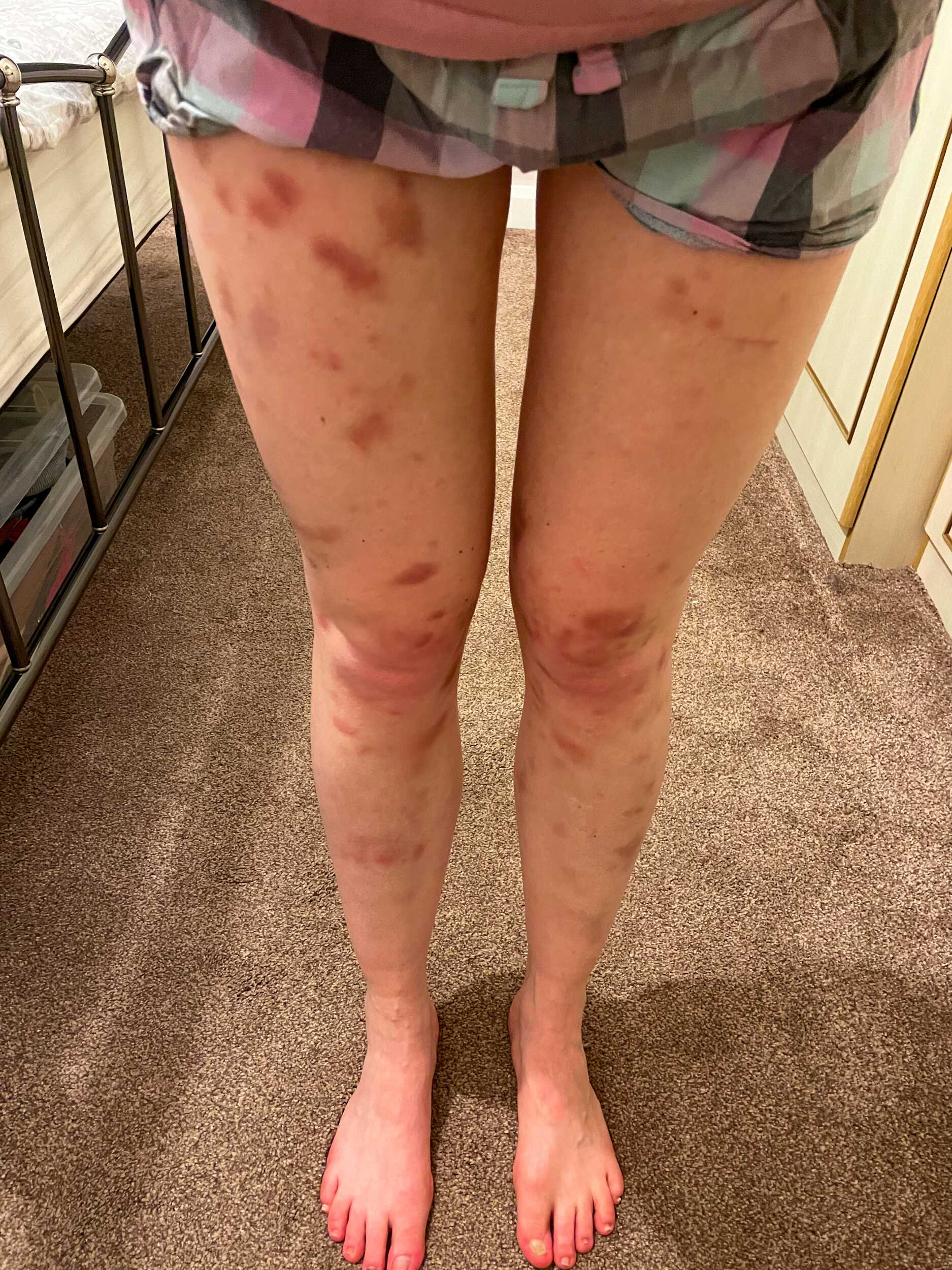 Bruises