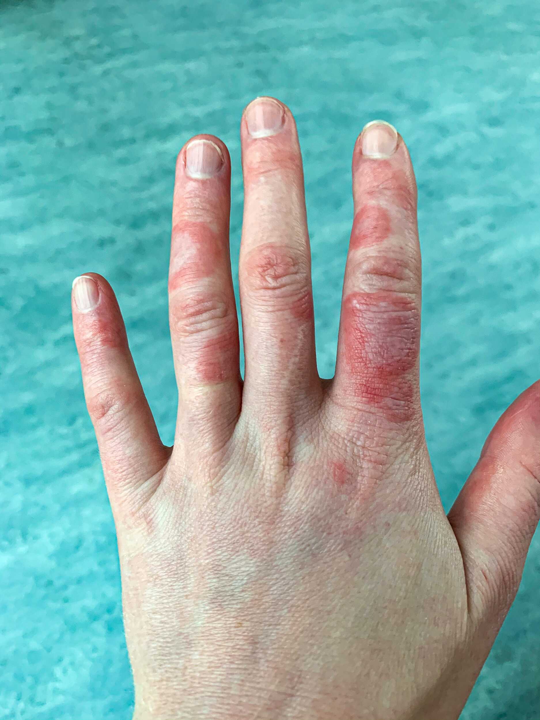 Lupus And Blisters On Hands