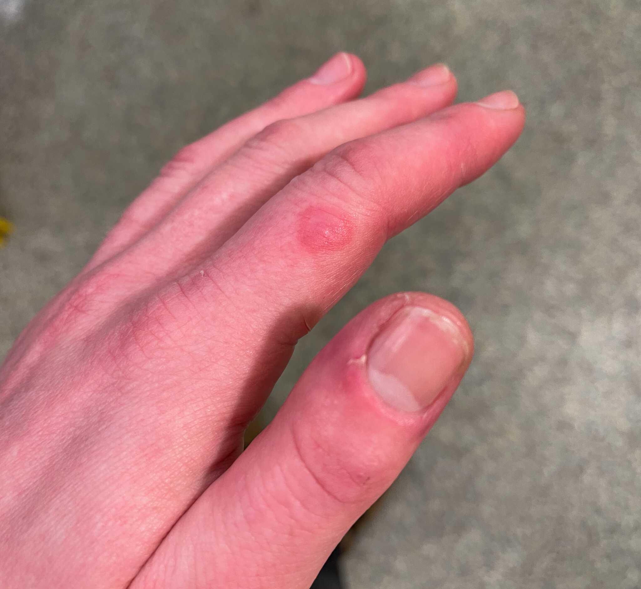 lupus rash on hands