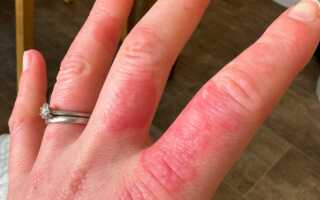 Lupus Rash