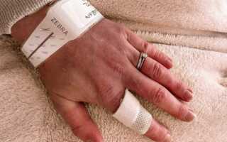 Lupus Rash