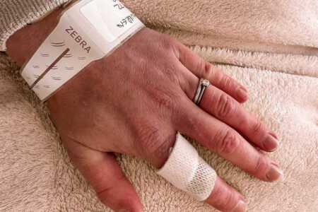 Lupus Rash