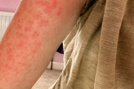 Lupus Rashes