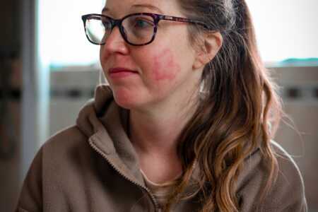 Lupus Rash
