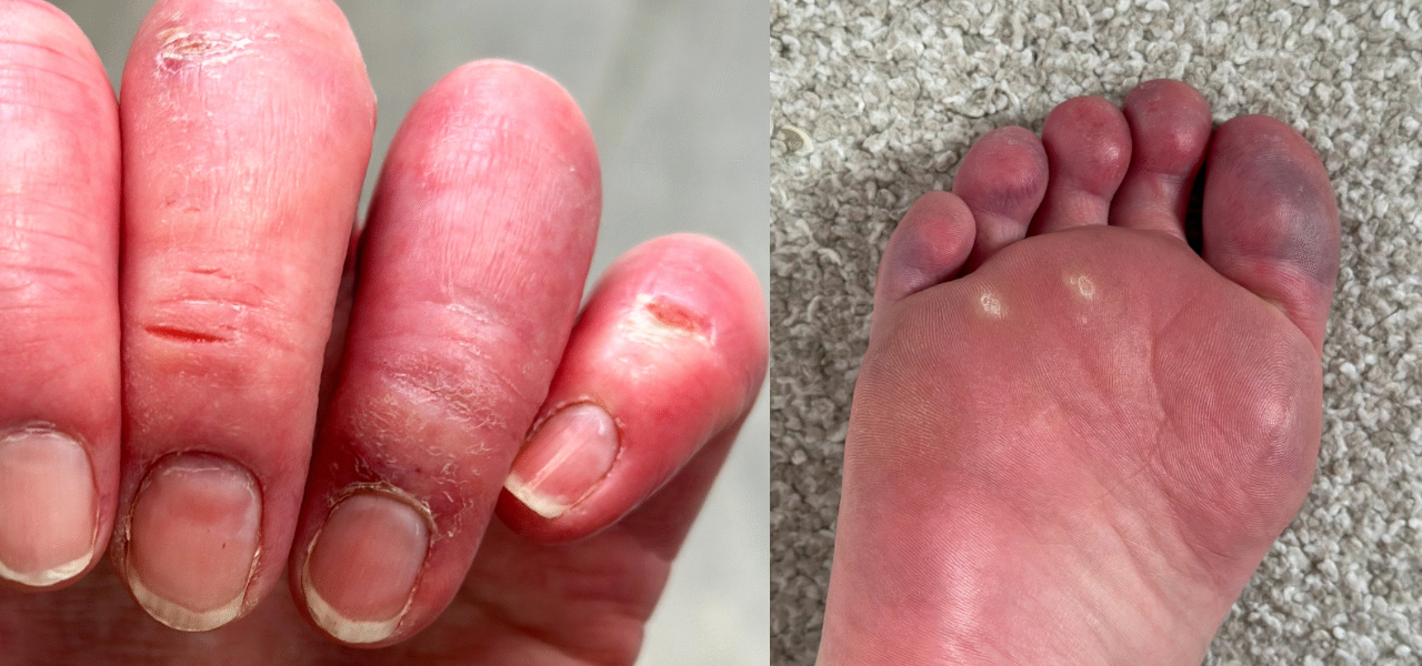 Circulation Lupus