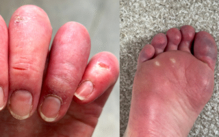 Circulation Lupus