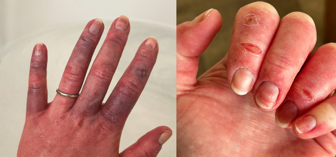 Severe Raynauds