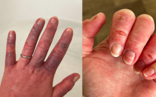 Severe Raynauds