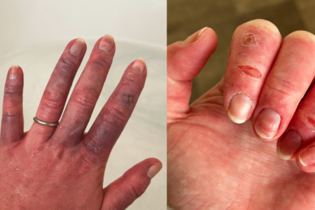Severe Raynauds