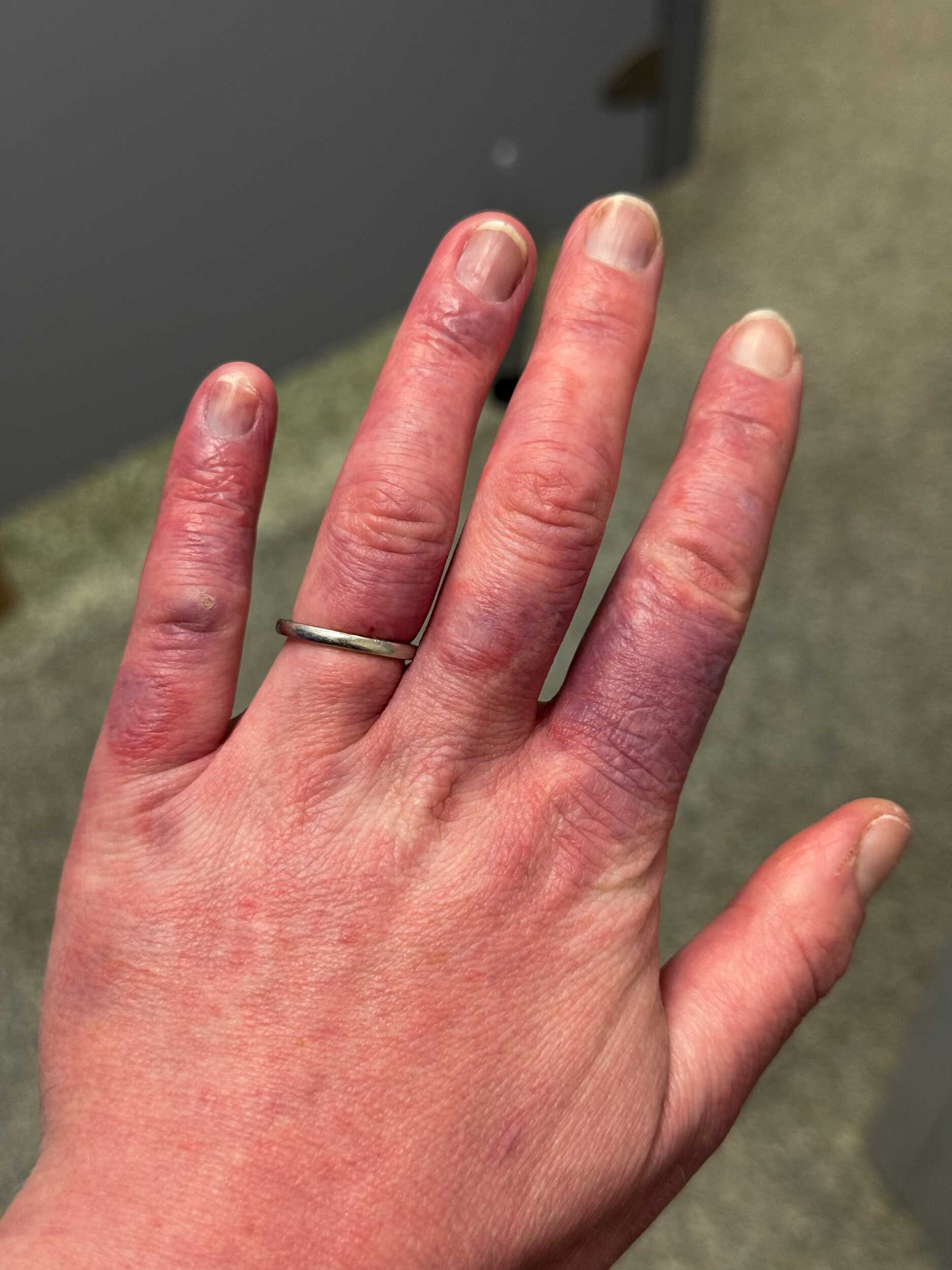 poor circulation