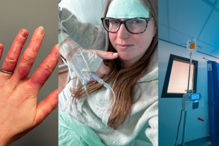 Raynauds