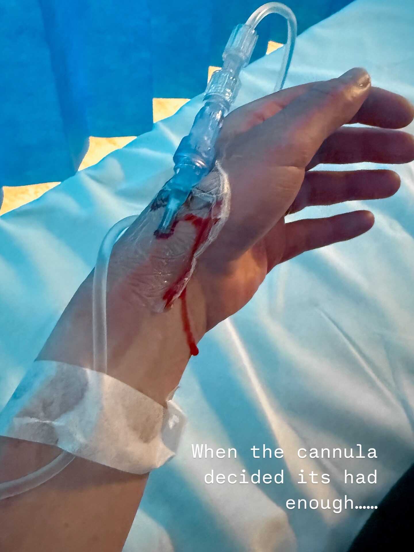 cannula