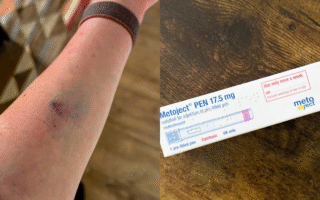bruised arm and injections