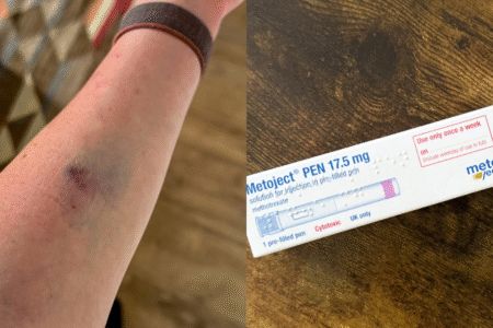bruised arm and injections