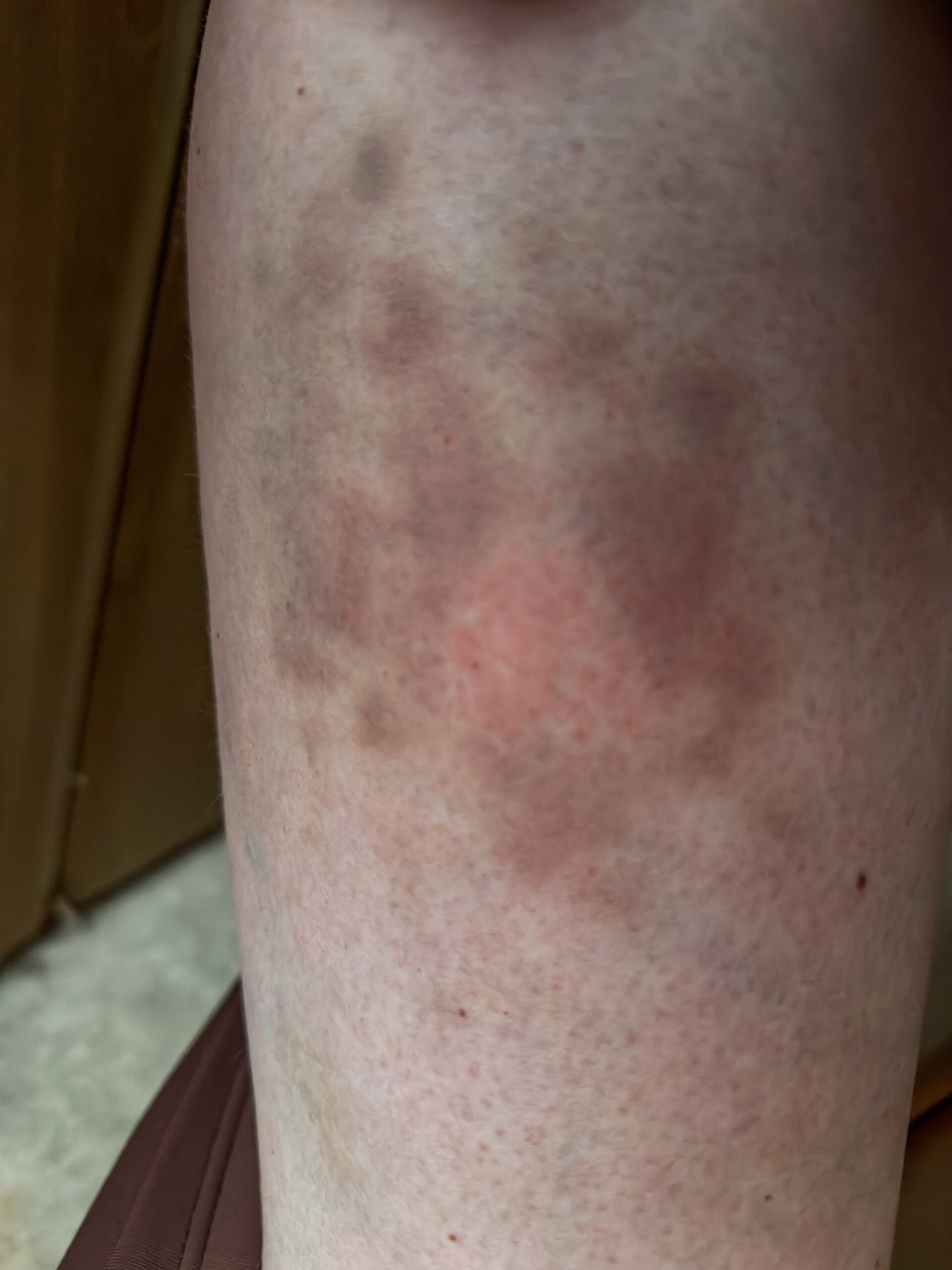 injection rash on thigh