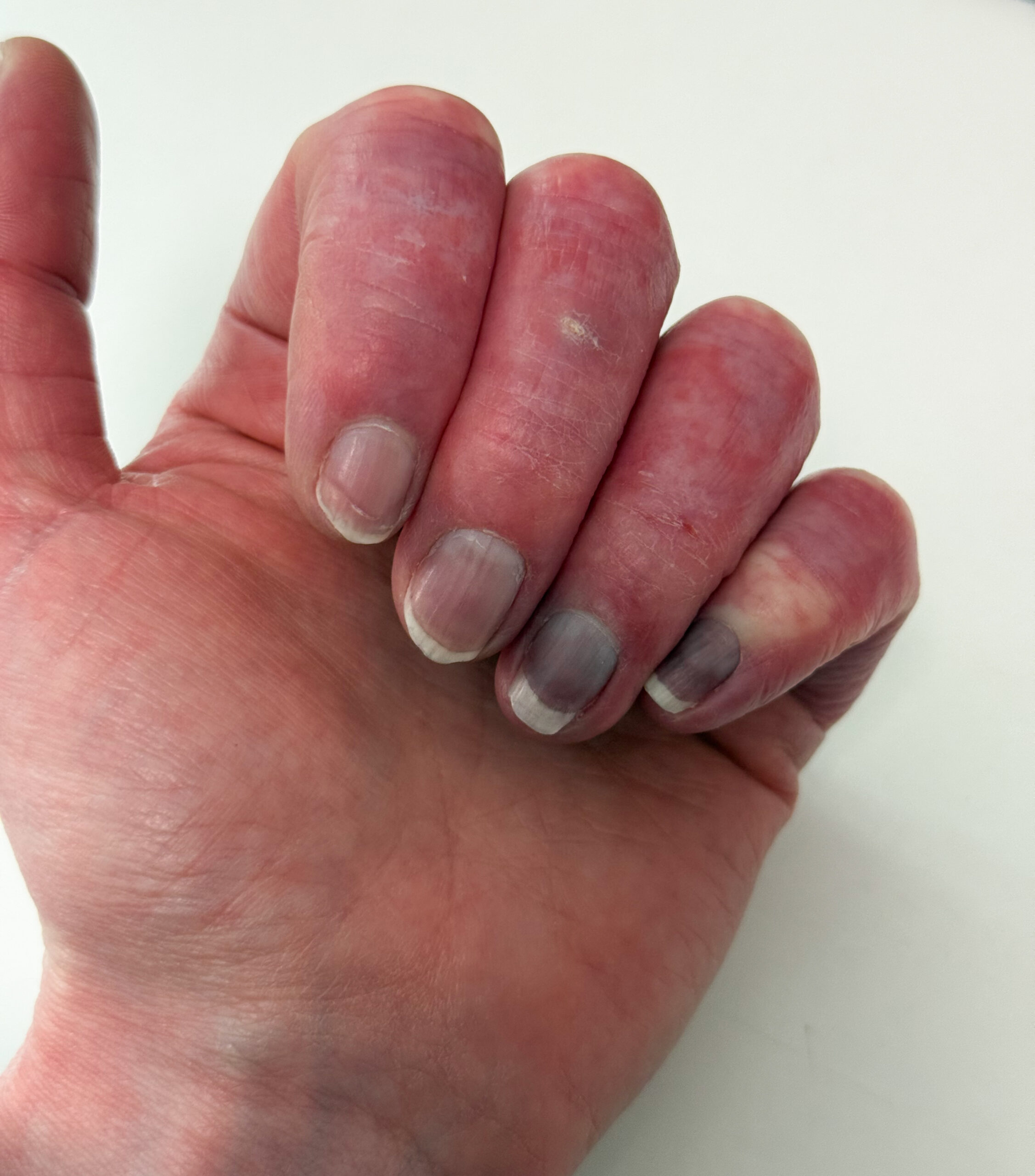 poor circulation in hands