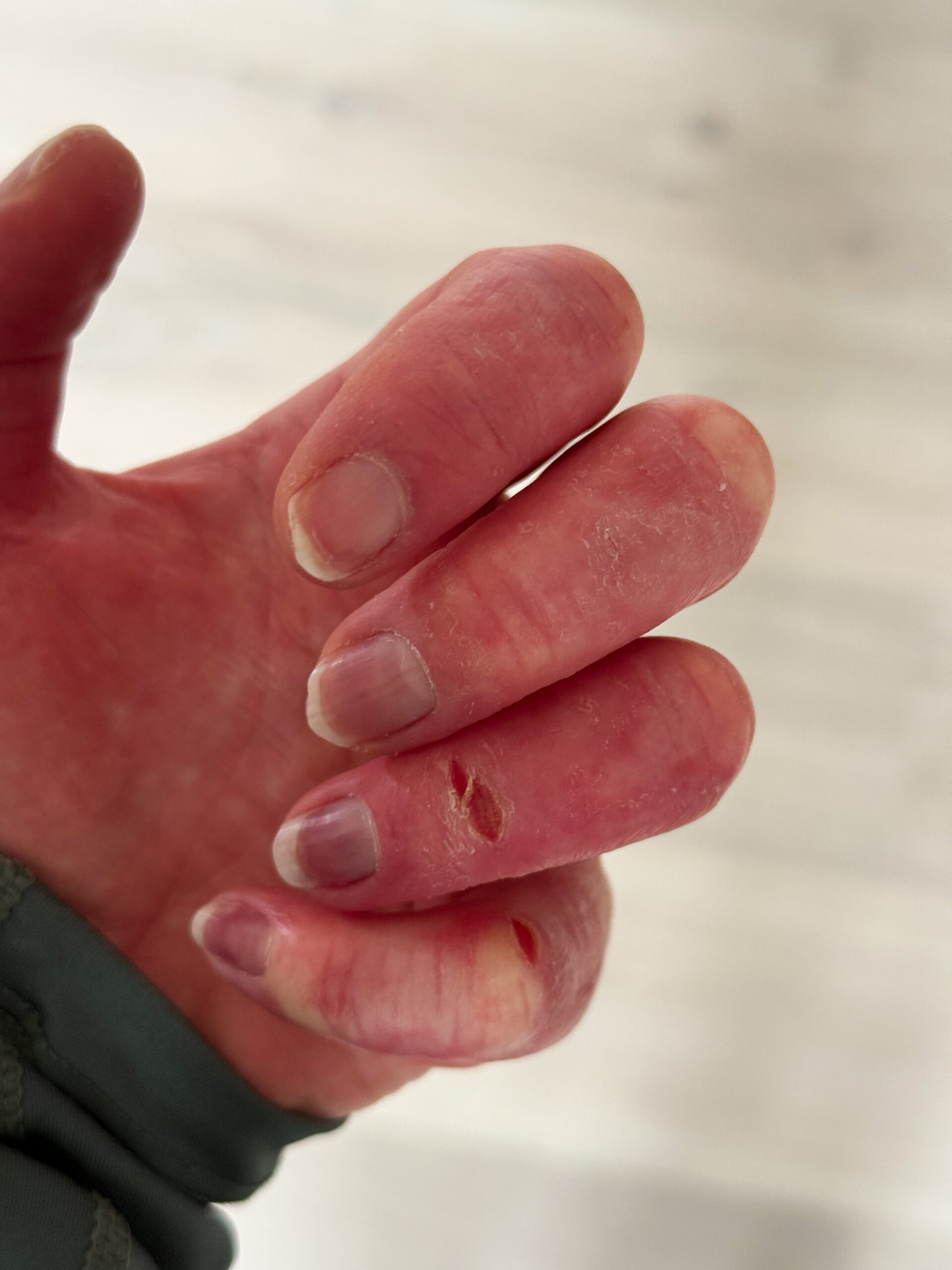 poor circulation in hands