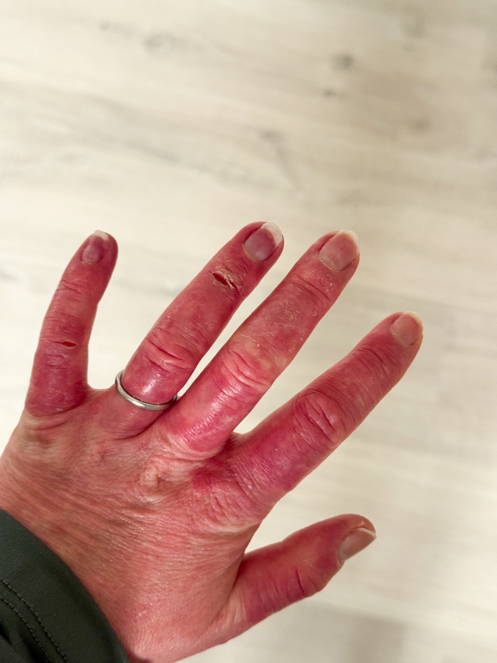 poor circulation in hands