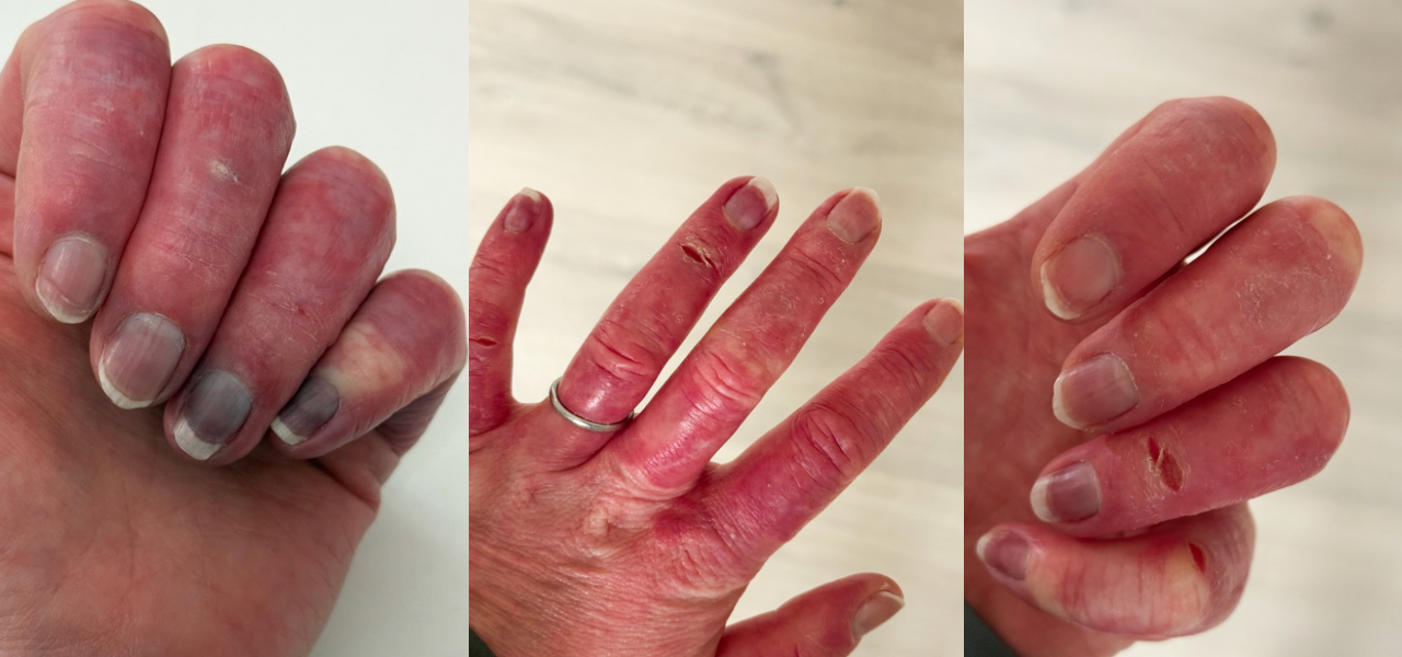 poor circulation on hands